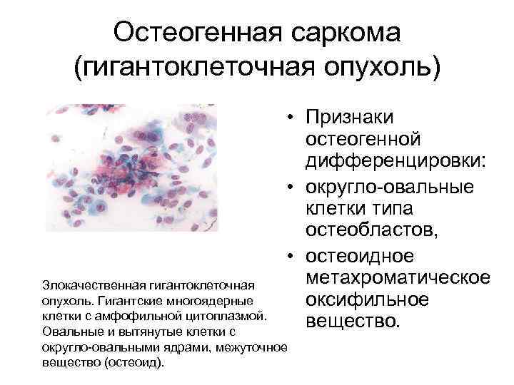 Остеогенная саркома (гигантоклеточная опухоль) • Признаки остеогенной дифференцировки: • округло-овальные клетки типа остеобластов, •