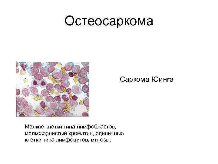 Остеосаркома Саркома Юинга Мелкие клетки типа лимфобластов, мелкозернистый хроматин, единичные клетки типа лимфоцитов, митозы.