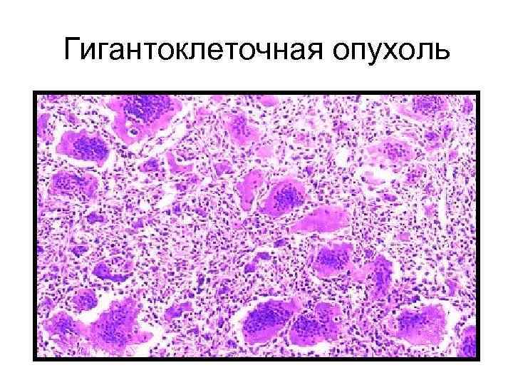 Морфологическая картина нодулярного теносиновита