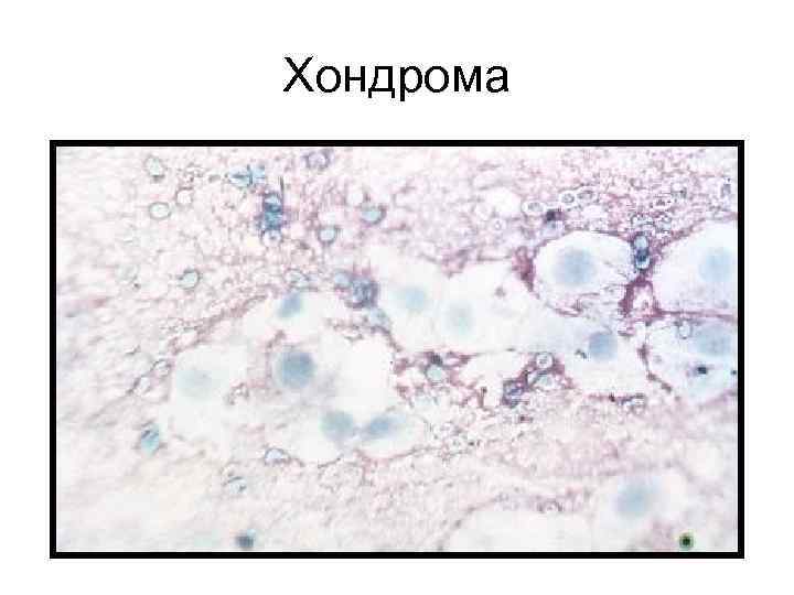 Хондрома микропрепарат рисунок