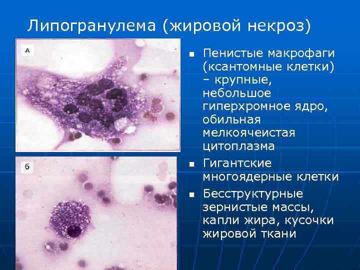 Липогранулема (жировой некроз) Пенистые макрофаги (ксантомные клетки) – крупные, небольшое гиперхромное ядро, обильная мелкоячеистая