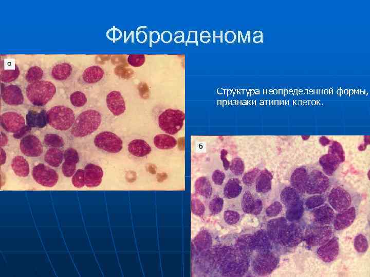 Фиброаденома Структура неопределенной формы, признаки атипии клеток. 