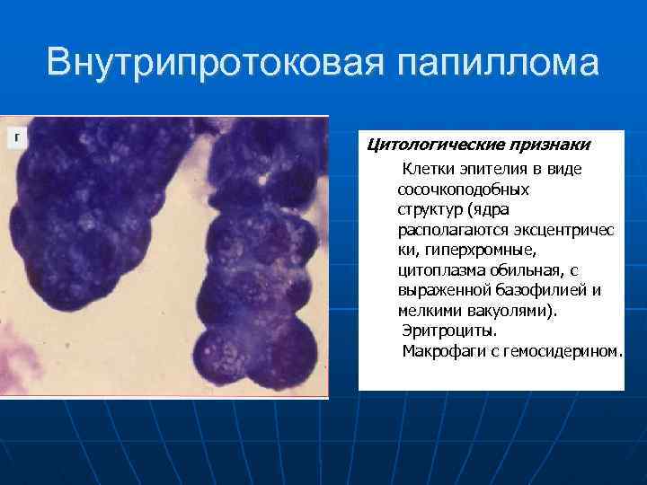 Внутрипротоковая папиллома Цитологические признаки. Клетки эпителия в виде сосочкоподобных структур (ядра располагаются эксцентричес ки,