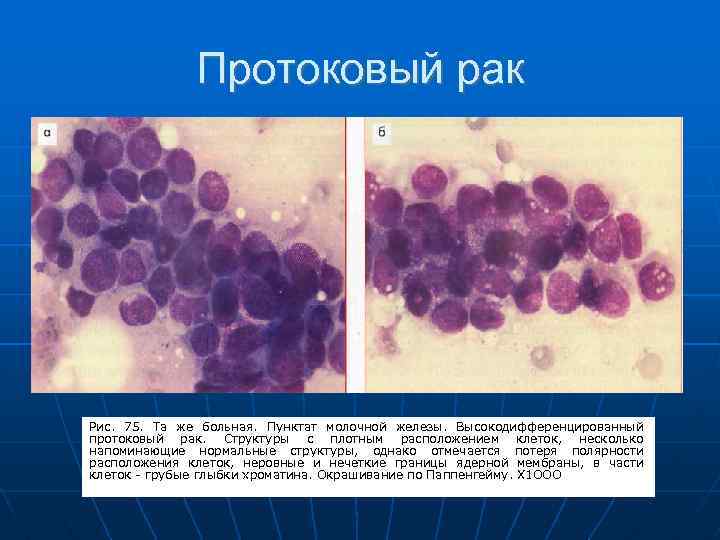 Цитологическая картина рака молочной железы