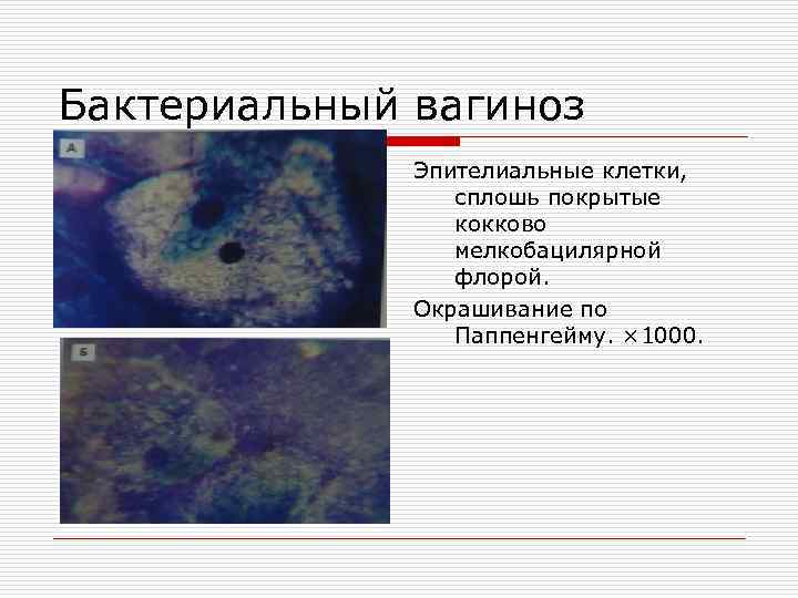 Бактериальный вагиноз Эпителиальные клетки, сплошь покрытые кокково мелкобацилярной флорой. Окрашивание по Паппенгейму. × 1000.