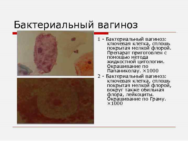 Бактериальный вагиноз 1 Бактериальный вагиноз: ключевая клетка, сплошь покрытая мелкой флорой. Препарат приготовлен с