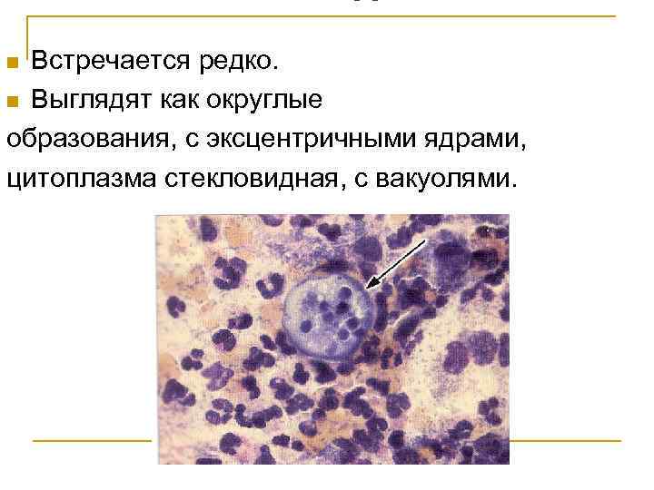 Амебы Встречается редко. n Выглядят как округлые образования, с эксцентричными ядрами, цитоплазма стекловидная, с
