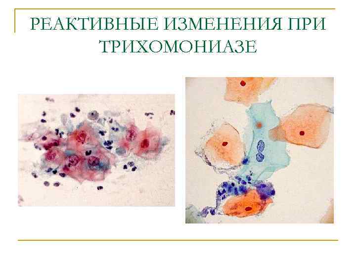 РЕАКТИВНЫЕ ИЗМЕНЕНИЯ ПРИ ТРИХОМОНИАЗЕ 