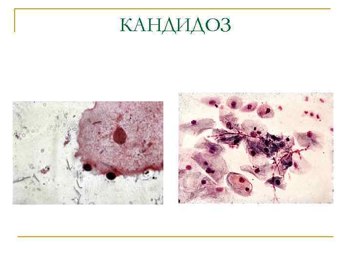 КАНДИДОЗ 