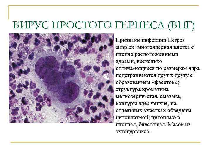 ВИРУС ПРОСТОГО ГЕРПЕСА (ВПГ) n Признаки инфекции Herpes simplex: многоядерная клетка с плотно расположенными