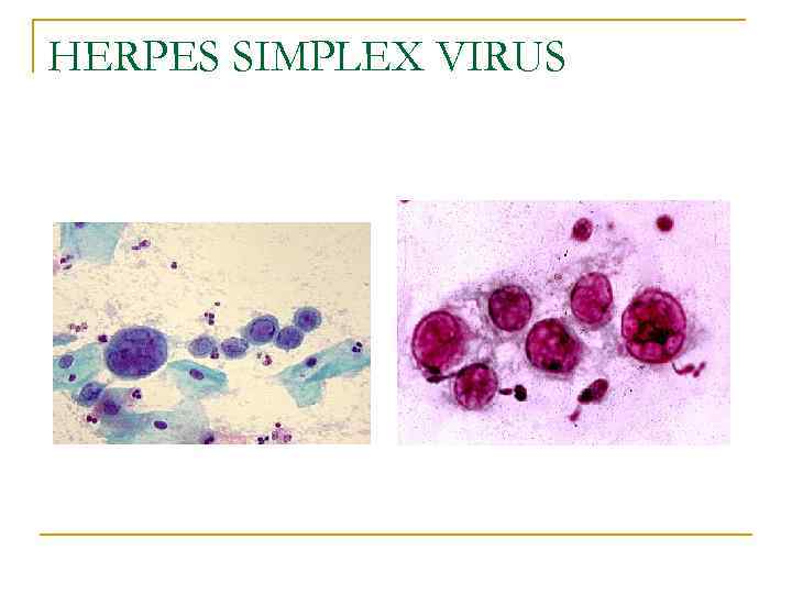 HERPES SIMPLEX VIRUS 