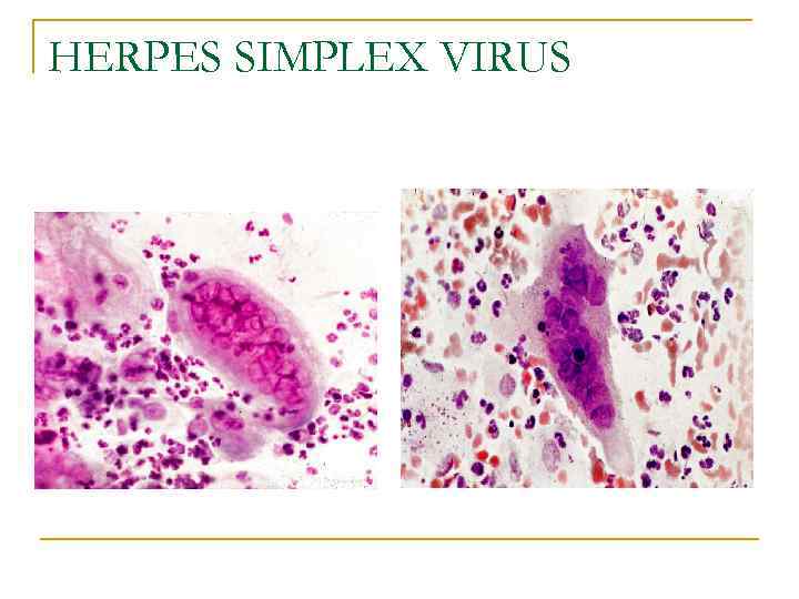 HERPES SIMPLEX VIRUS 