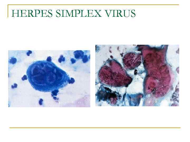 HERPES SIMPLEX VIRUS 