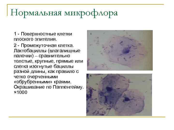 Нормальная микрофлора 1 - Поверхностные клетки плоского эпителия. 2 - Промежуточная клетка. Лактобациллы (влагалищные