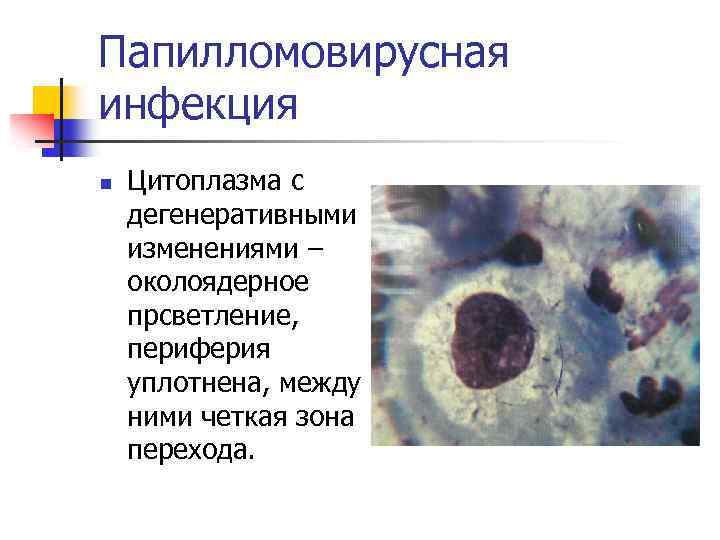 Папилломовирусная инфекция n Цитоплазма с дегенеративными изменениями – околоядерное прсветление, периферия уплотнена, между ними