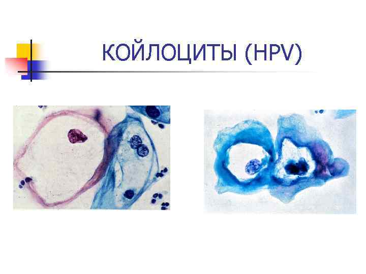 КОЙЛОЦИТЫ (HPV) 