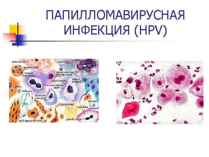 ПАПИЛЛОМАВИРУСНАЯ ИНФЕКЦИЯ (HPV) 