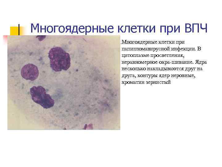 Многоядерные клетки при ВПЧ n Многоядерные клетки при папилломавирусной инфекции. В цитоплазме просветления, неравномерное