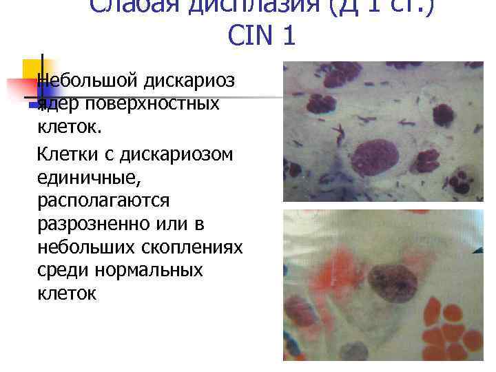 Слабая дисплазия (Д 1 ст. ) CIN 1 Небольшой дискариоз ядер поверхностных клеток. Клетки