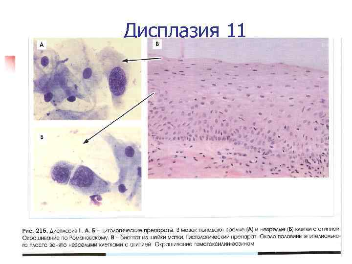 Дисплазия 11 