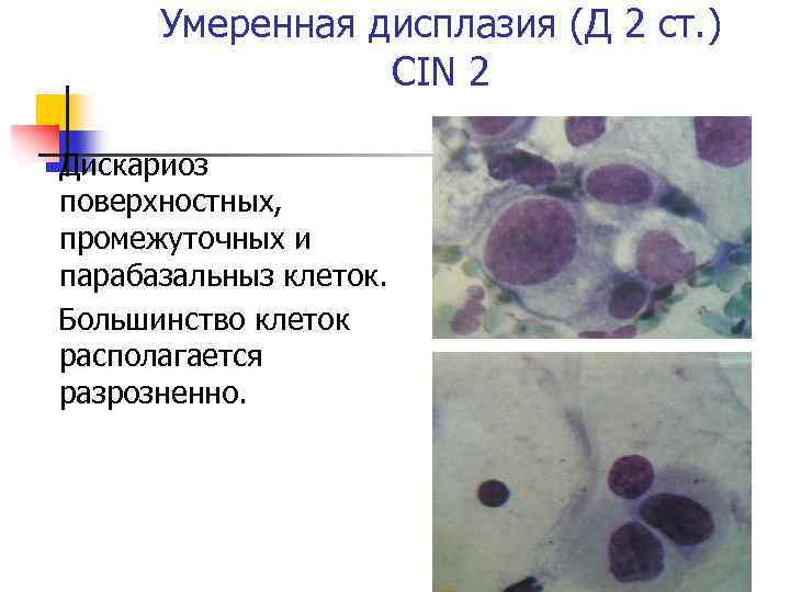 Умеренная дисплазия (Д 2 ст. ) CIN 2 Дискариоз поверхностных, промежуточных и парабазальныз клеток.