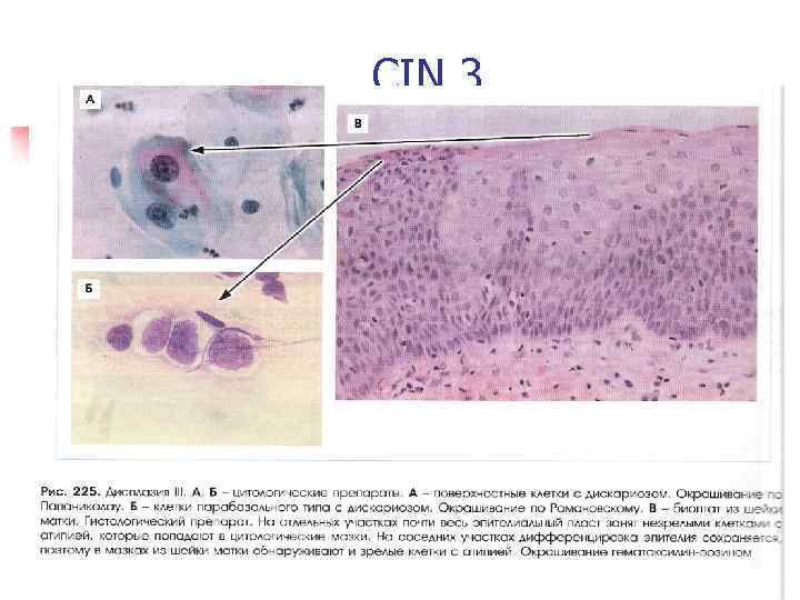 CIN 3 