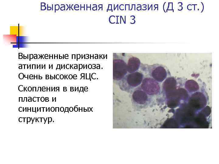 Выраженная дисплазия (Д 3 ст. ) CIN 3 Выраженные признаки атипии и дискариоза. Очень