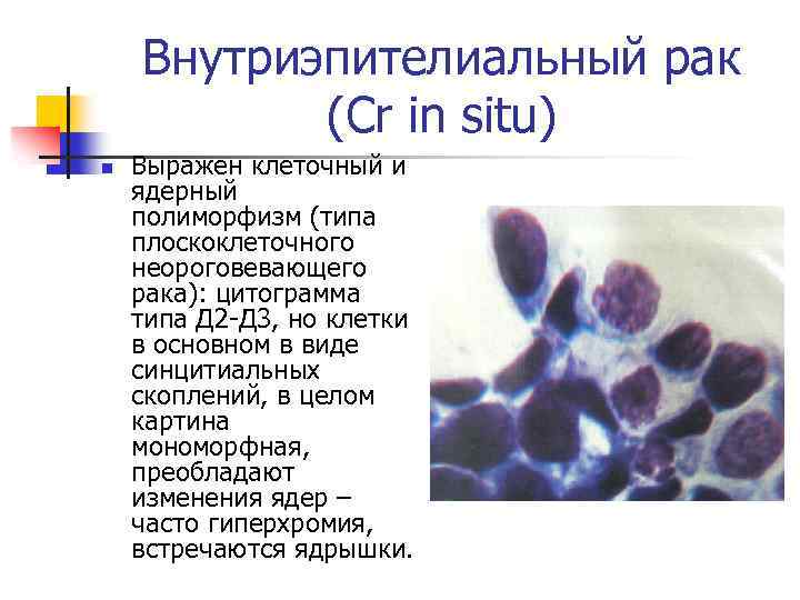 Внутриэпителиальный рак (Cr in situ) n Выражен клеточный и ядерный полиморфизм (типа плоскоклеточного неороговевающего