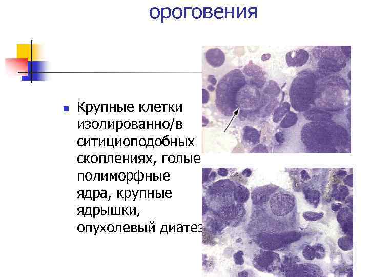 ороговения n Крупные клетки изолированно/в ситициоподобных скоплениях, голые полиморфные ядра, крупные ядрышки, опухолевый диатез