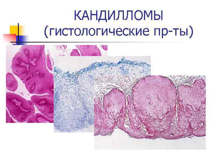 КАНДИЛЛОМЫ (гистологические пр-ты) 