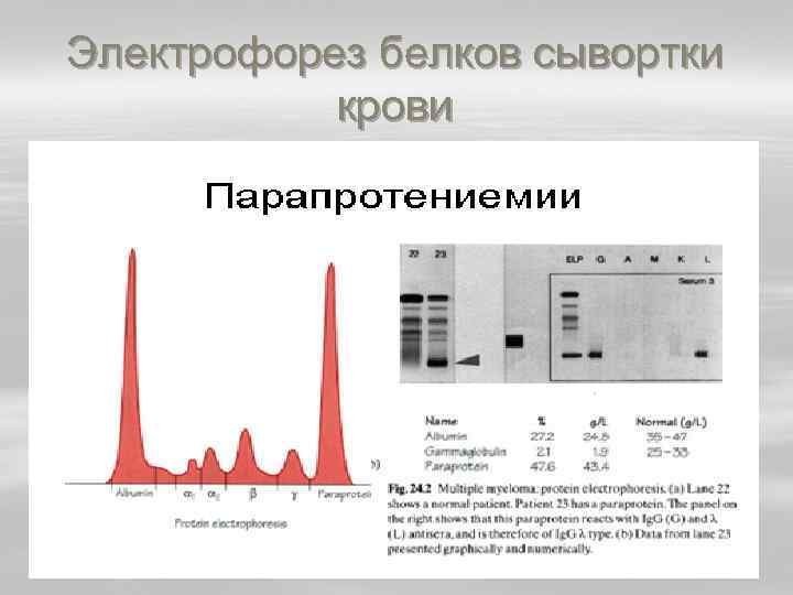 Электрофорез белков. Электрофорез сыворотки крови. Фракции белков плазмы крови электрофорез. Электрофорез белков сыворотки крови принцип метода. Электрофореграмма белков сыворотки крови расшифровка.