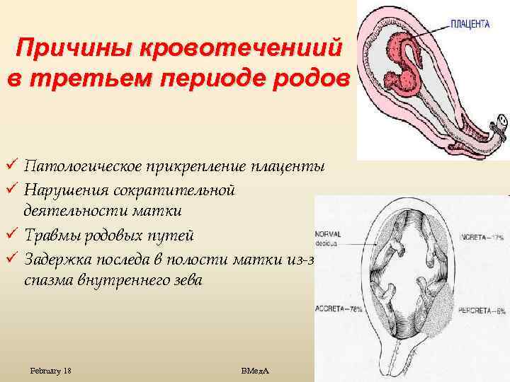 Образование плаценты прикрепление зародыша. Патологическое прикрепление плаценты. Задержка частей последа в полости матки.