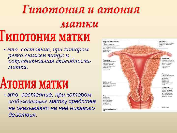 Гипотония и атония матки - это состояние, при котором резко снижен тонус и сократительная