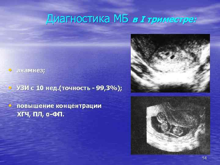 Диагностика МБ в I триместре: • анамнез; • УЗИ с 10 нед. (точность -