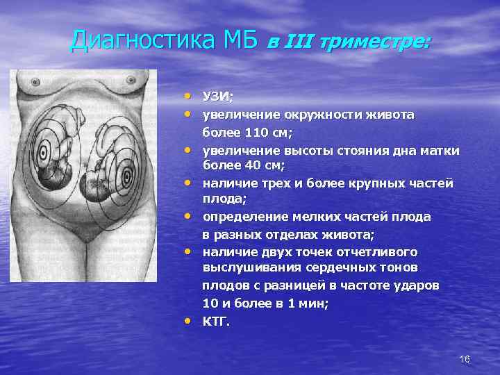 Диагностика МБ в III триместре: • УЗИ; • увеличение окружности живота • • •