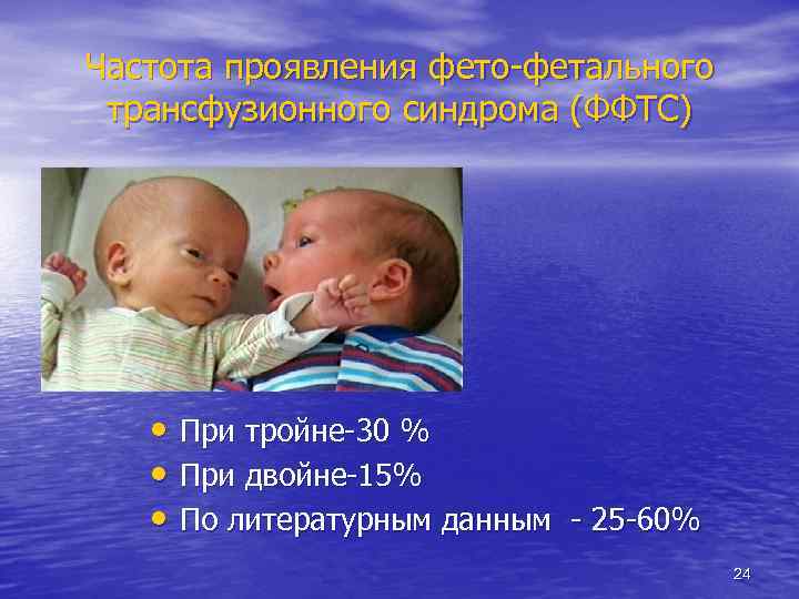 Частота проявления фето-фетального трансфузионного синдрома (ФФТС) • При тройне-30 % • При двойне-15% •