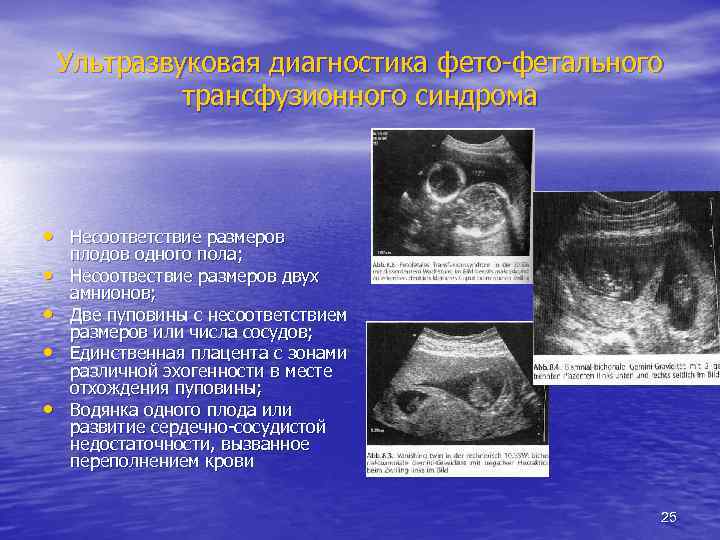 Ультразвуковая диагностика фето-фетального трансфузионного синдрома • Несоответствие размеров • • плодов одного пола; Несоотвествие