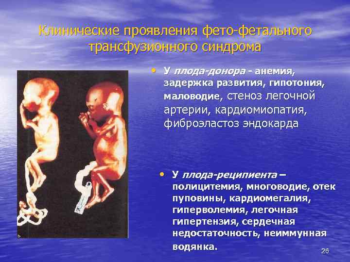 Клинические проявления фето-фетального трансфузионного синдрома • У плода-донора - анемия, задержка развития, гипотония, маловодие,