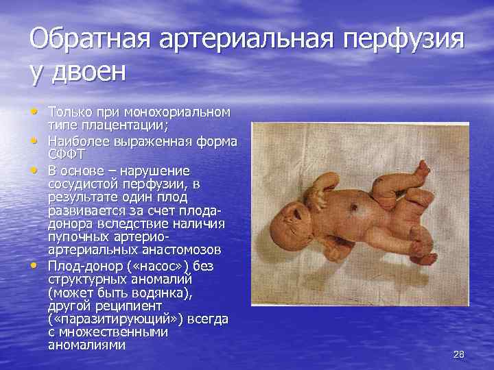 Обратная артериальная перфузия у двоен • Только при монохориальном • • • типе плацентации;