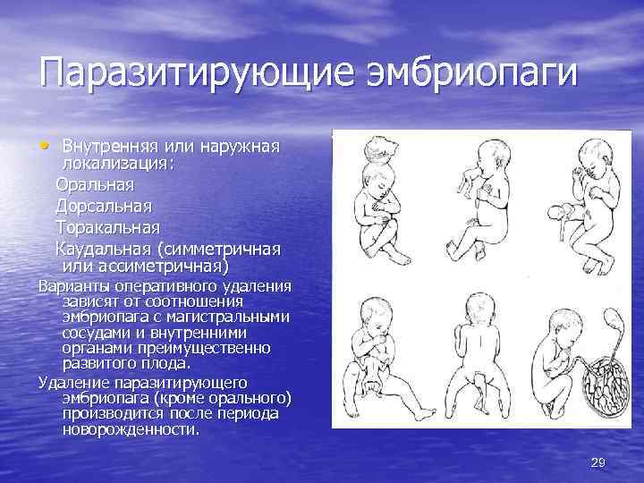 Паразитирующие эмбриопаги • Внутренняя или наружная локализация: Оральная Дорсальная Торакальная Каудальная (симметричная или ассиметричная)