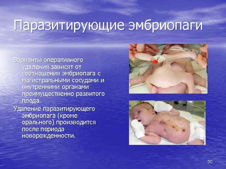 Паразитирующие эмбриопаги Варианты оперативного удаления зависят от соотношения эмбриопага с магистральными сосудами и внутренними