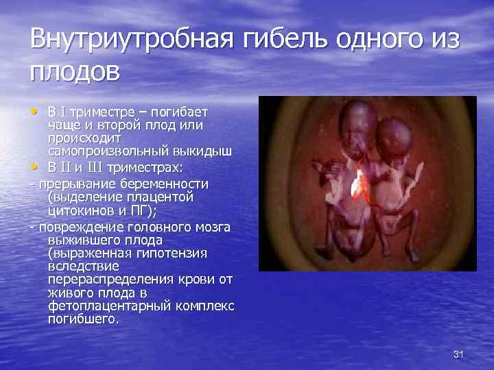 Внутриутробная гибель одного из плодов • В I триместре – погибает чаще и второй