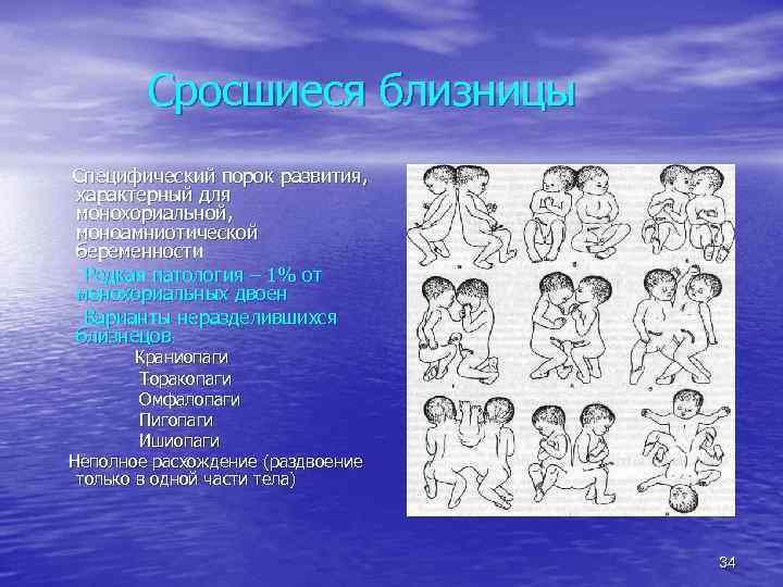 Сросшиеся близницы Специфический порок развития, характерный для монохориальной, моноамниотической беременности Редкая патология – 1%