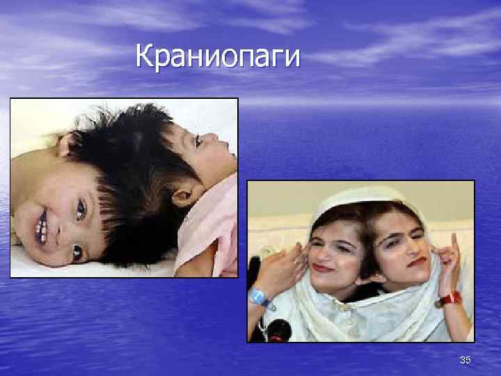 Краниопаги 35 