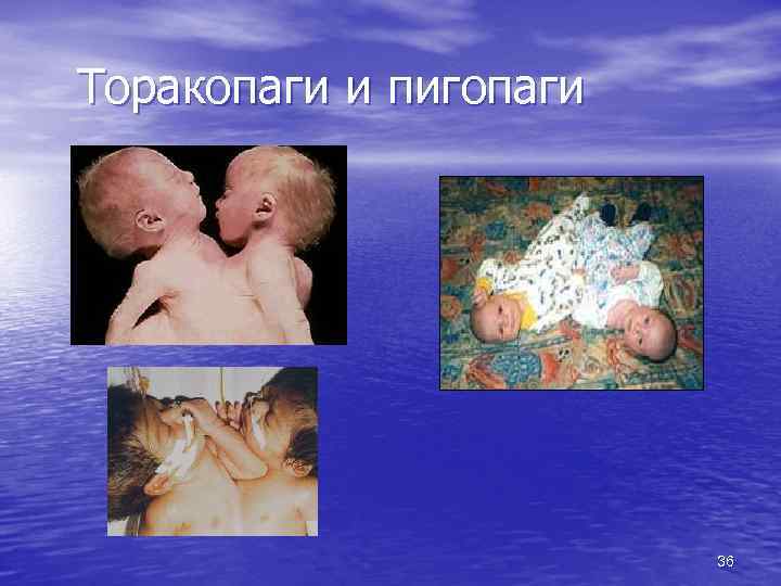 Торакопаги и пигопаги 36 