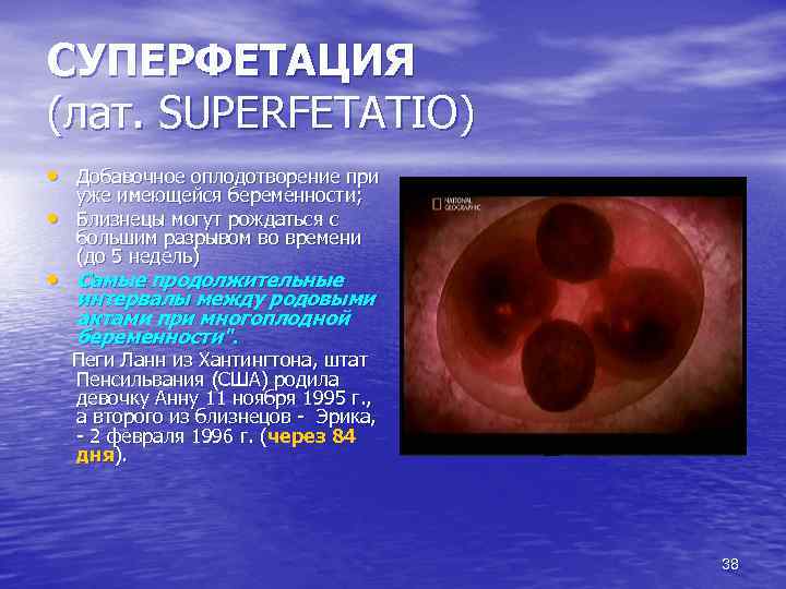 СУПЕРФЕТАЦИЯ (лат. SUPERFETATIO) • Добавочное оплодотворение при • уже имеющейся беременности; Близнецы могут рождаться