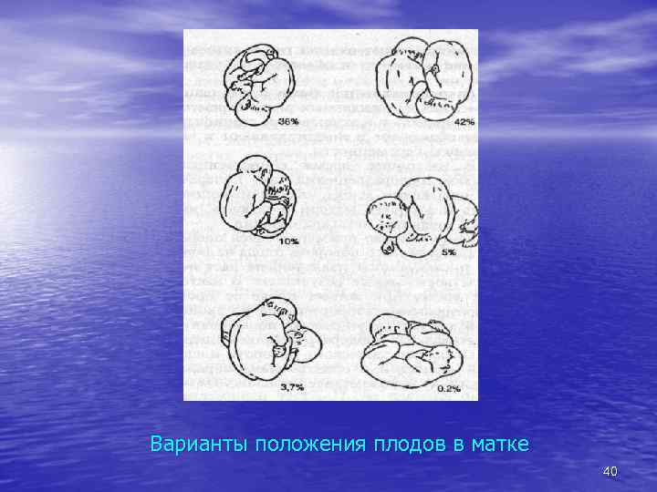 Варианты положения плодов в матке 40 