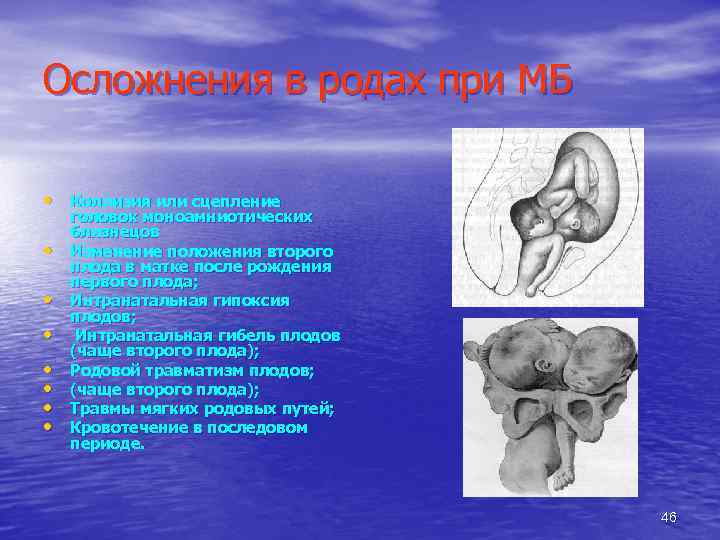 Осложнения в родах при МБ • Коллизия или сцепление • • головок моноамниотических близнецов
