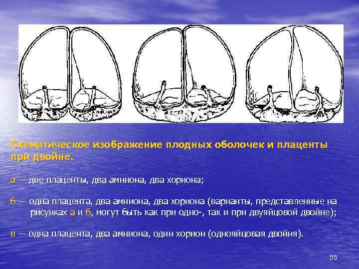 Схематическое изображение плодных оболочек и плаценты при двойне. а — две плаценты, два амниона,