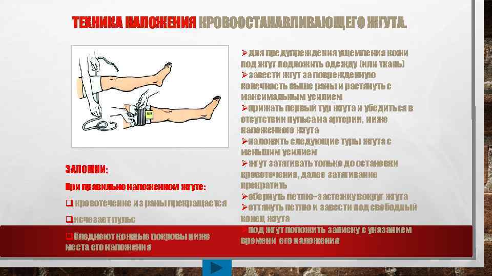 ТЕХНИКА НАЛОЖЕНИЯ КРОВООСТАНАВЛИВАЮЩЕГО ЖГУТА. ЗАПОМНИ: При правильно наложенном жгуте: q кровотечение из раны прекращается